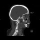 Teardrop figure, orbital floor fracture, blow-out fracture: CT - Computed tomography